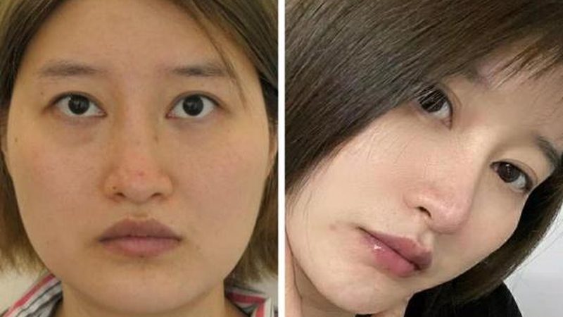 抬头纹肉毒素副作用