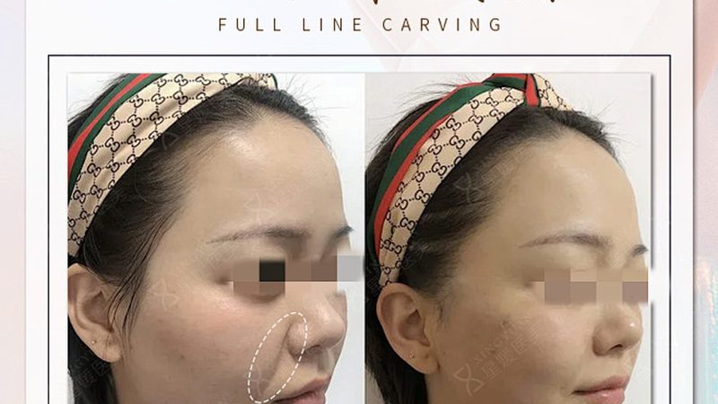 小标题：了解埋线提升