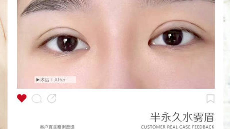 厦门公立医院双眼皮修复：揭秘专业与安全的选择