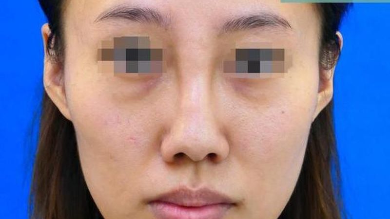 揭秘瘦脸贴片：价格背后的技术秘密