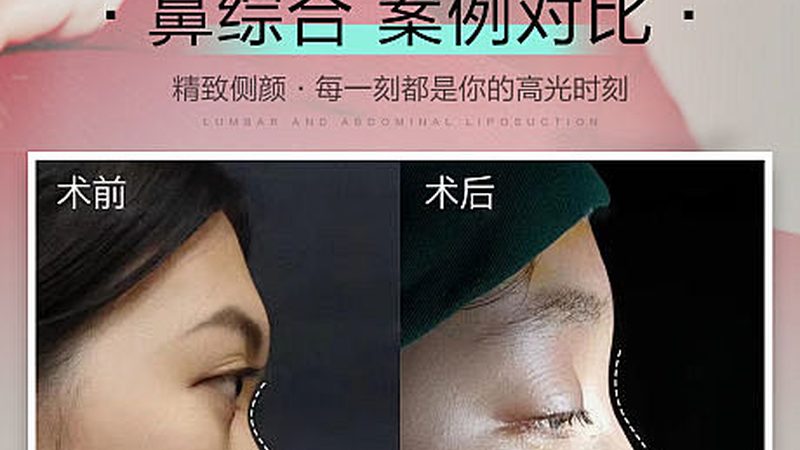 小标题：埋线提升的常见误区