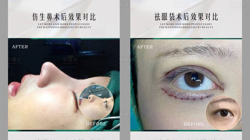 广州男士光子嫩肤，揭秘团购价格背后的真相